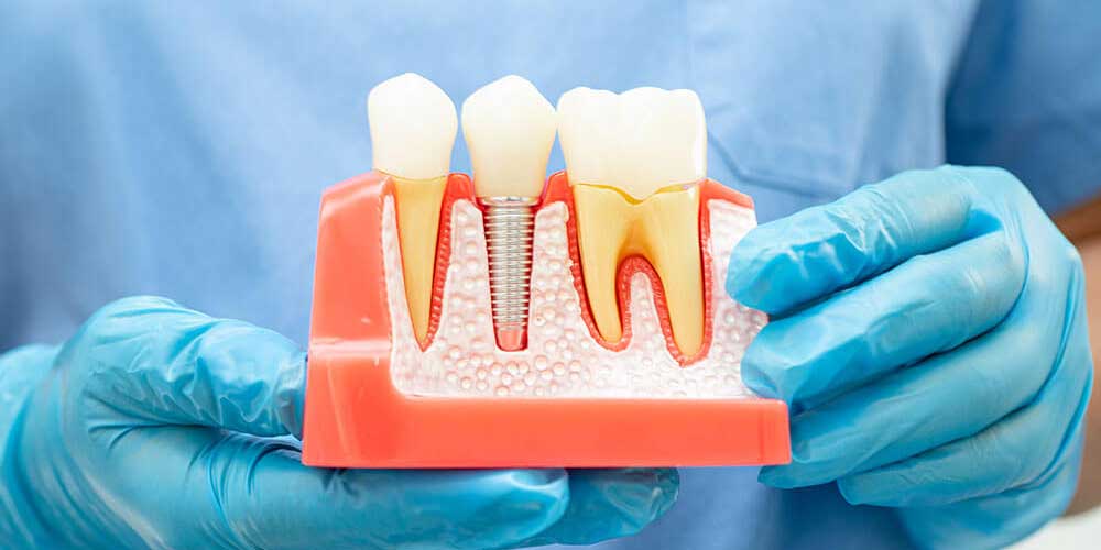 Dental Implants